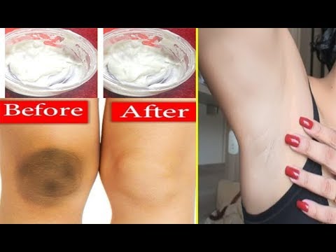 How To Lighten Dark Knees, Dark Elbows, Dark Underarms - Lighten Your Dark Body Parts Naturally