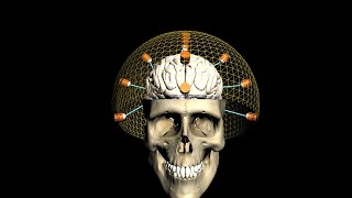 MRgFUS Revolutionizes Treatment of Parkinsonian and Essential Tremors!