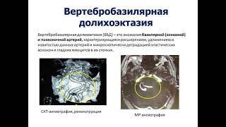 Аномалия сосудов мозга и невралгия тройничного нерва. Вертебробазилярная долихоэктазия.