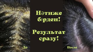 1 ЖАСАҒАННАН ҚАЙЫЗҒАҚ ЖОҚ БОЛАДЫ! МАЙЛЫ БАС ТЕРІСІН ТАЗАЛАЙДЫ! ИЗБАВЬСЯ ОТ ПЕРХОТИ С 1 ПРИМЕНЕНИЯ!