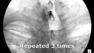 Cervical Interlaminar Epidural Steroid Injection - ThePainSource.com