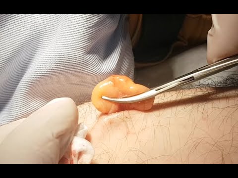 Forearm Lipoma Excision with Laser