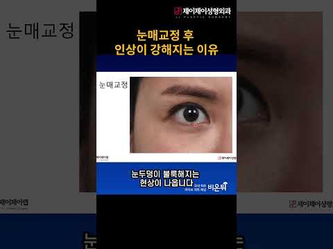 <strong>눈매교정</strong> 후 인상이 강해지는 이유#<strong>눈매교정</strong> #shorts