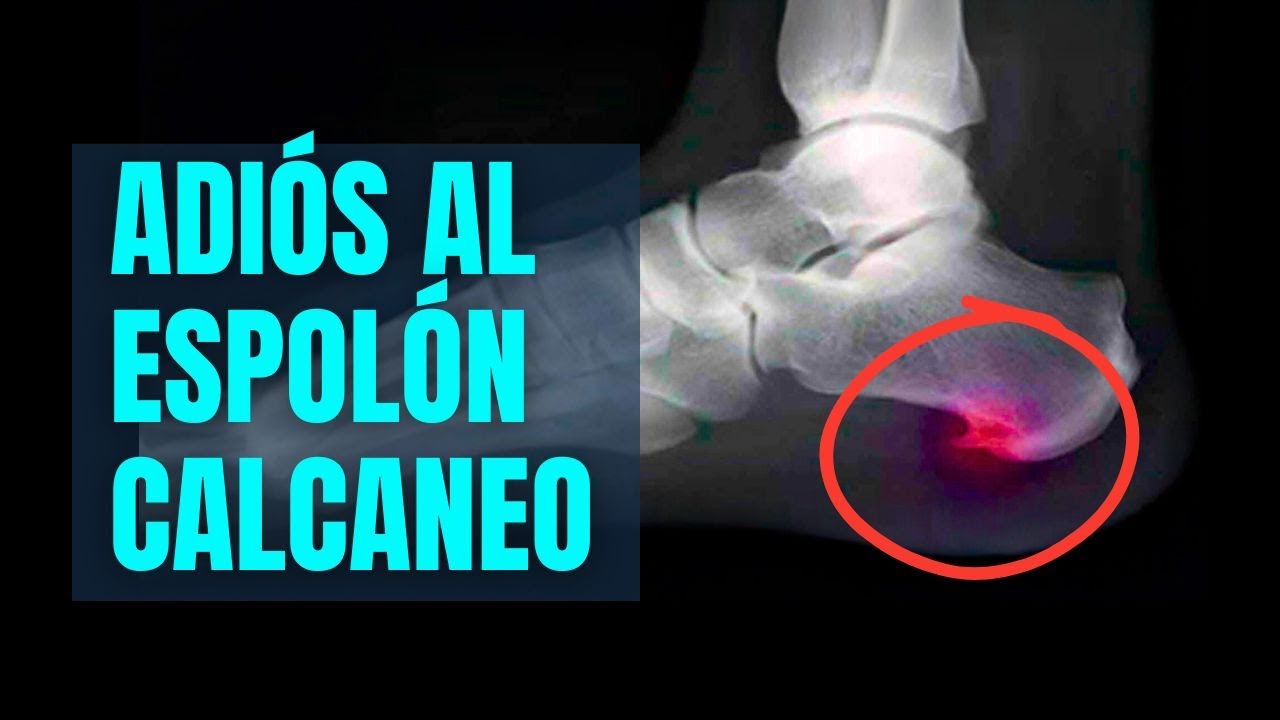 🔥 ¡ADIÓS AL ESPOLÓN CALCÁNEO! 3 Trucos Caseros que REALMENTE Funcionan 🦶❌