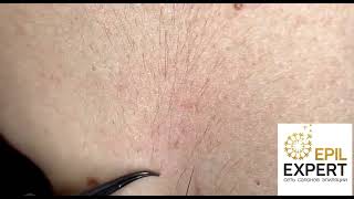 Как правильно подготовиться к эпиляции током