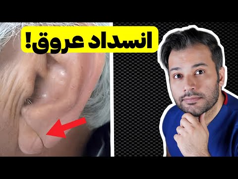 5 علامت مخفی انسداد عروق که باید بدونید