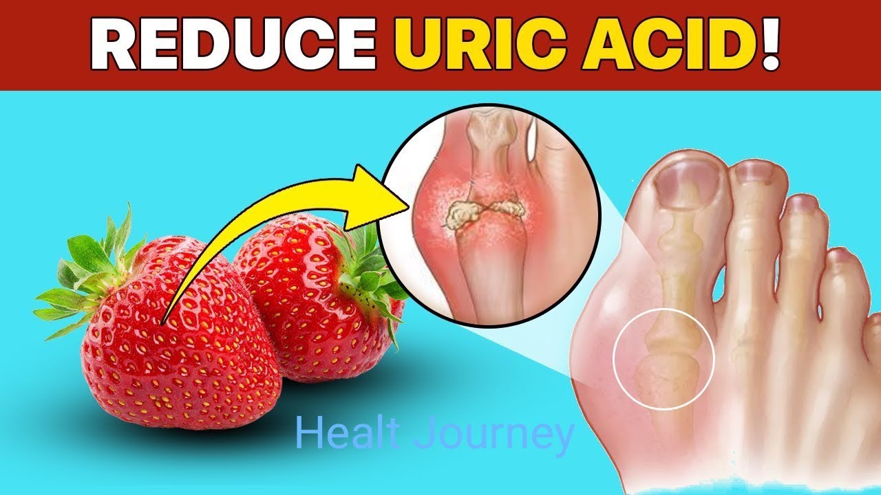 Gout Buster Foods: Fight Joint Pain Deliciously!/Healt Journey