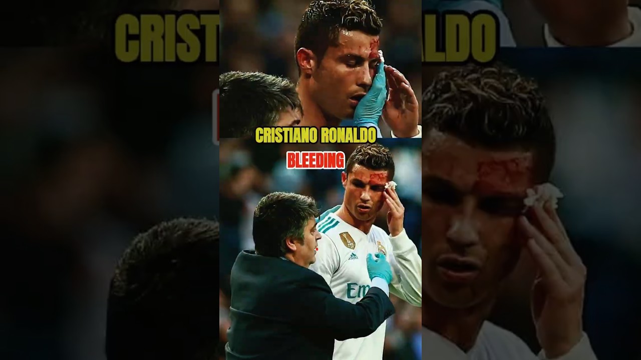 Cristiano Ronaldo Bleeding 