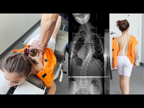 Scoliosis Treatment with Gonstead Chiropractic Care |Ep2| Dr. Rahim