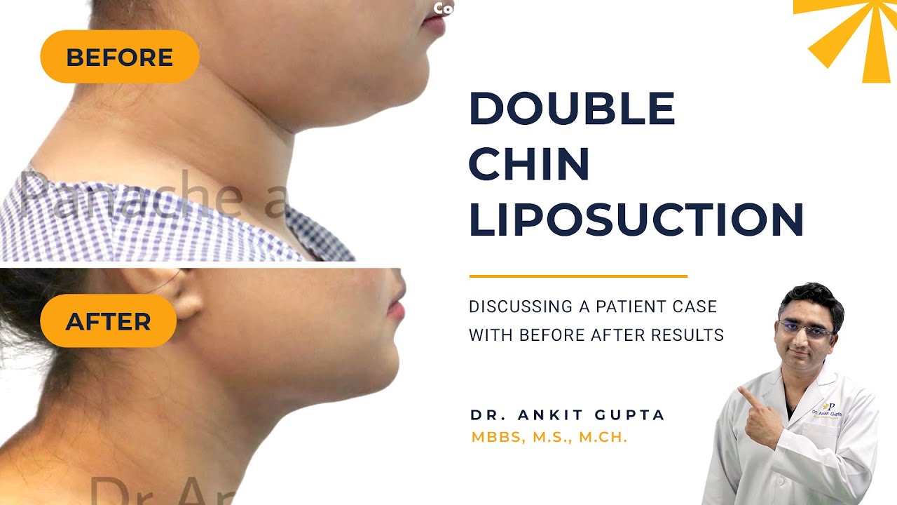 Lipodissolve To The Double Chin – MOFAF