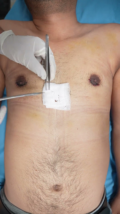 Gynecomastia surgery in delhi | Manboobs Surgery cost