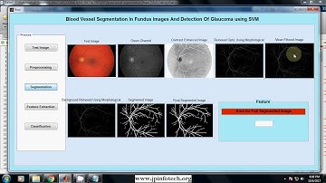 Blood Vessel Segmentation in Fundus Images and Detection of Glaucoma using SVM | Matlab Project
