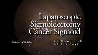 Laparoscopic Sigmoidectomy for Cancer Sigmoid | FULL VIDEO WITH VOICE