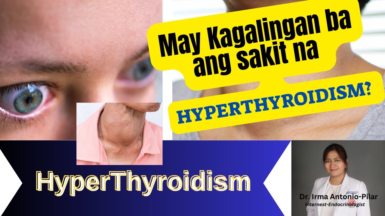 May Kagalingan ba ang sakit na Hyperthyroidism?