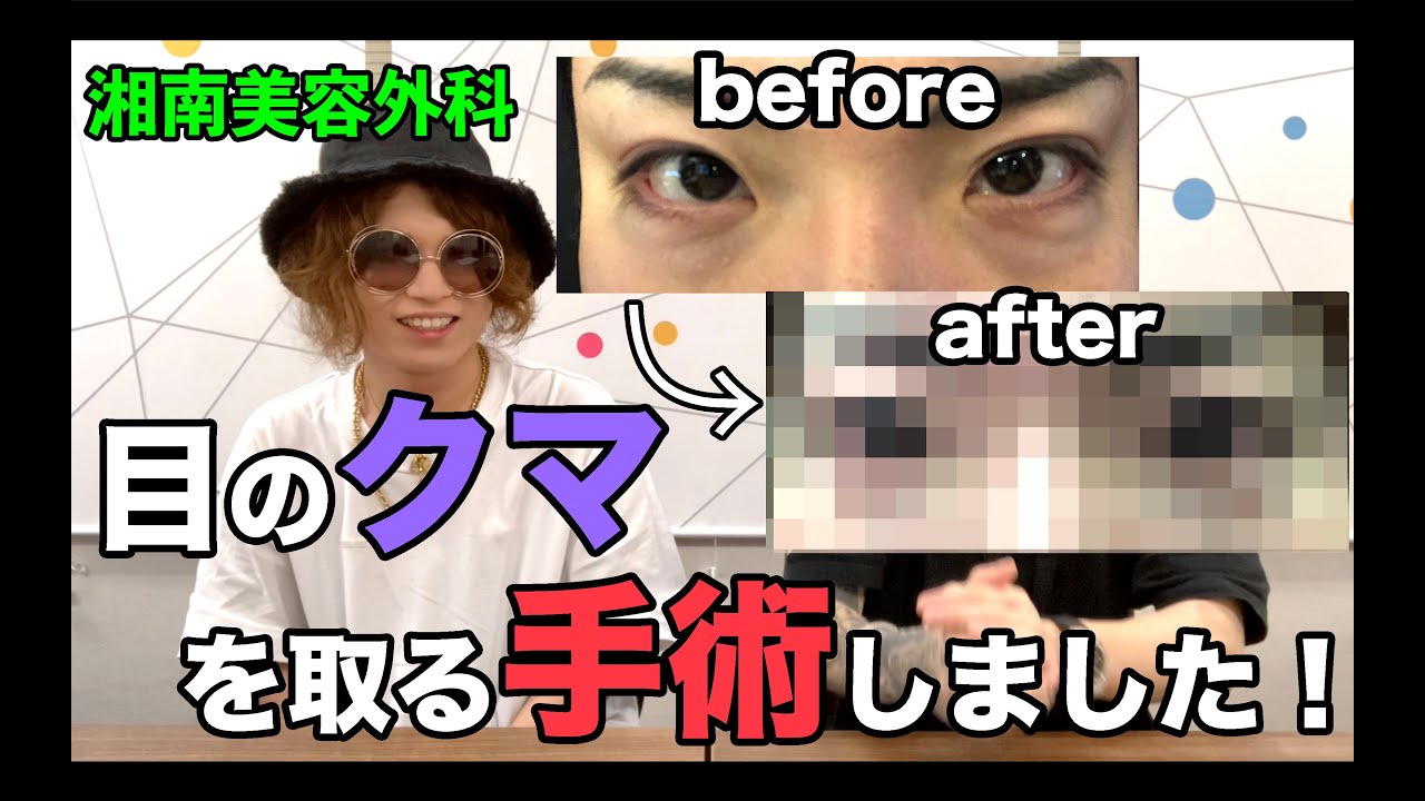 整形 湘南美容外科で目のクマを取る手術をしたら劇的に変わった Youtube 整形 湘南美容外科で目のクマを取る手術をしたら劇的に変わった Youtube