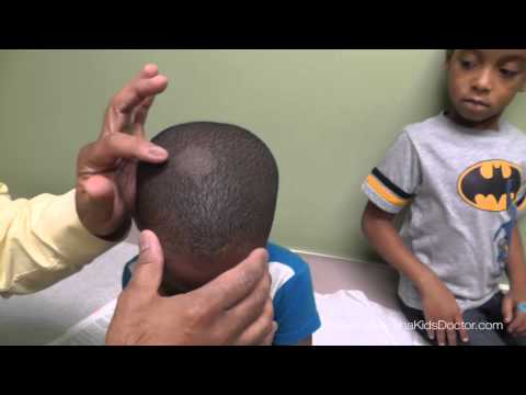 Video: Ringworm - Symptoms, Treatment, Ringworm On The Head In Children