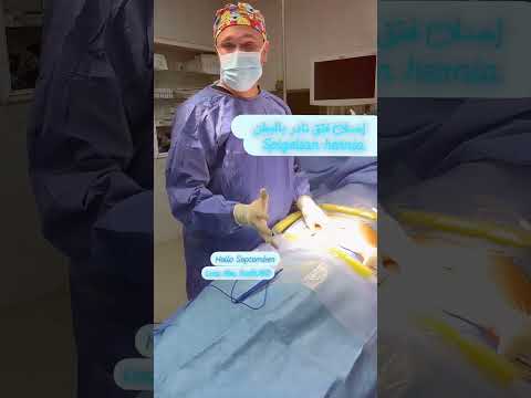 عمليات الفتق بأنواعها