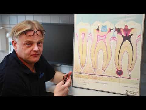 Wideo: Zapalenie Miazgi - Przyczyny I Objawy Zapalenia Miazgi