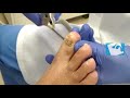 tratamiento uña onicomicosis (hongos en las uñas)