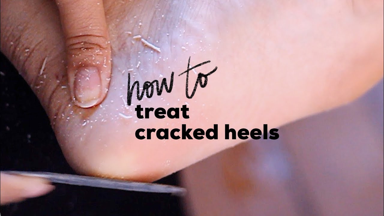 cracked heel cream | homemade CRACKED heel cream |DIY cracked heel |winter  hacks for cracked heels - YouTube