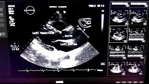 Normal Echocardiogram study