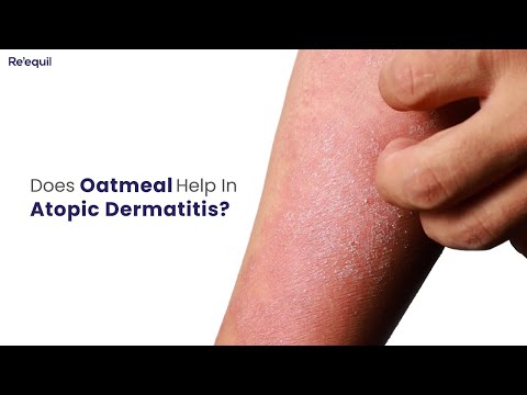 Video: Berloque dermatitis ni nini?