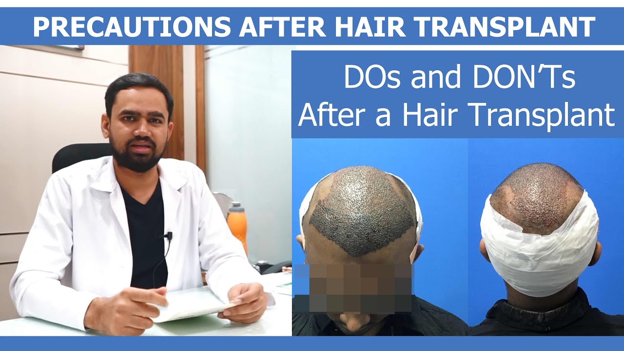 Affordable and Best FUE Hair Transplant  La Densitae