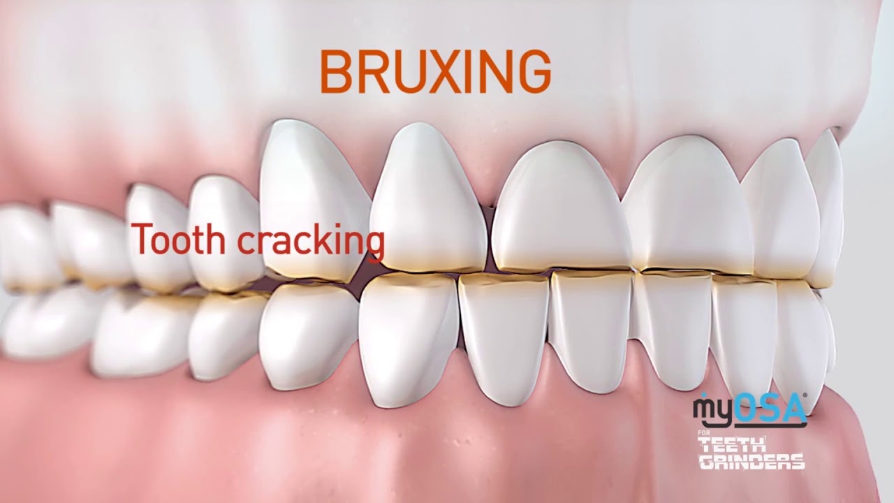 Сильно сжимаю зубы. Бруксизм зубы стертость.