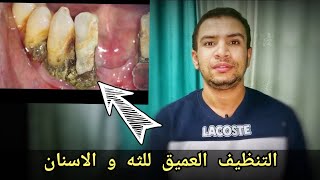 كيف تقوم بازاله تكلسات الاسنان العالقه منذ سنوات| تنظيف عميق للثه