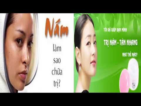 Trị nám tàn nhang hiệu quả tại nhà -  trị nám sau khi sinh em bé