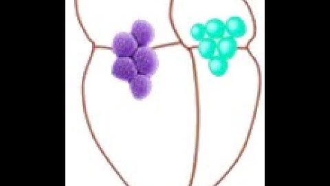 Infective Endocarditis Overview_Dr Pradeep Rangappa