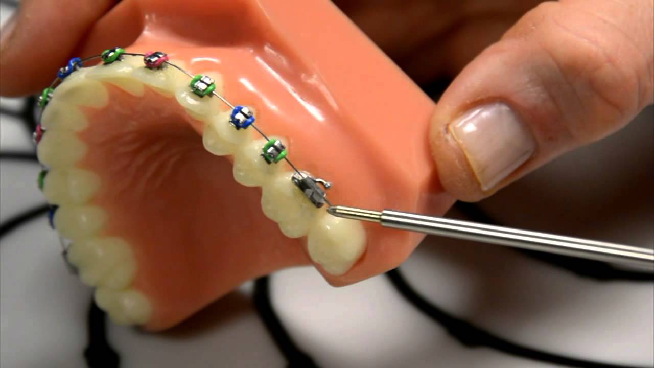Wax: A Great Temporary Fix for Braces with Poking Wire - YouTube