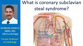 What is coronary subclavian steal syndrome?
