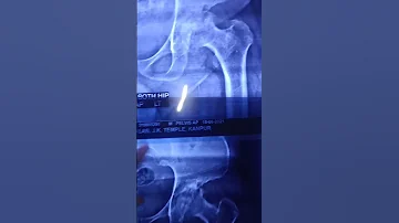 AVN hip | X- Ray Change After Therapy | Dr. Vijay Prakash 7007968664 | #shorts