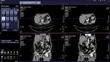MM Oncology Tutorial