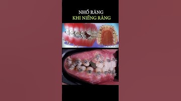 Tại sao phải nhổ răng khi niềng răng #braces #orthodontist #dental