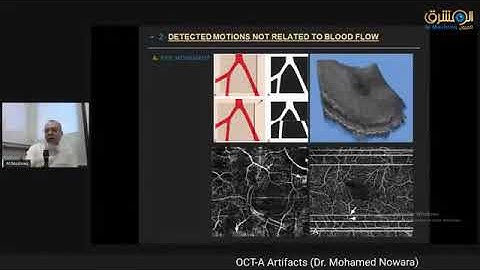 OCT A Artifacts Dr Mohamed Nowara