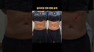 실리프팅 전후 변화 후기 비교, 복부 거상 리프팅 효과는?