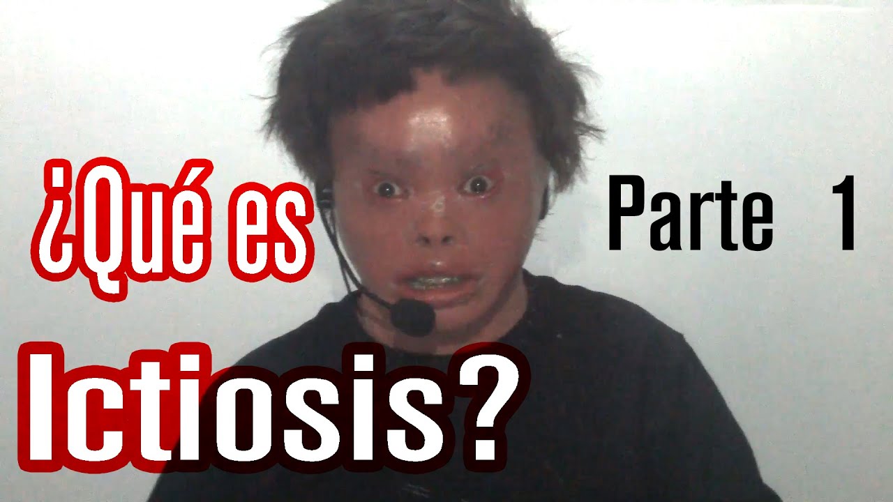 VideoBlog ¿Qué es Ictiosis? 1ra Parte YouTube