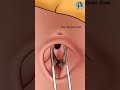 ASMR Satisfying Belly Button Ring Piercing Removal Animation Treatment |#asmr #animation #shorts