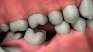 Dental Implants  Replace Missing Teeth  Diagnosis