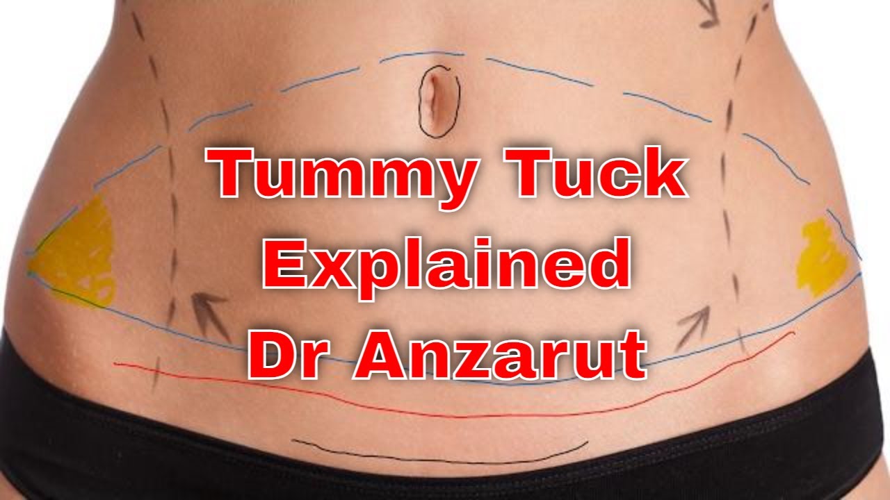 tummy tuck surgery 