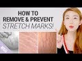 How To Get Rid of Stretch Marks Fast | Natural Remedies for Stretch Mark Removal | What's TRENDing