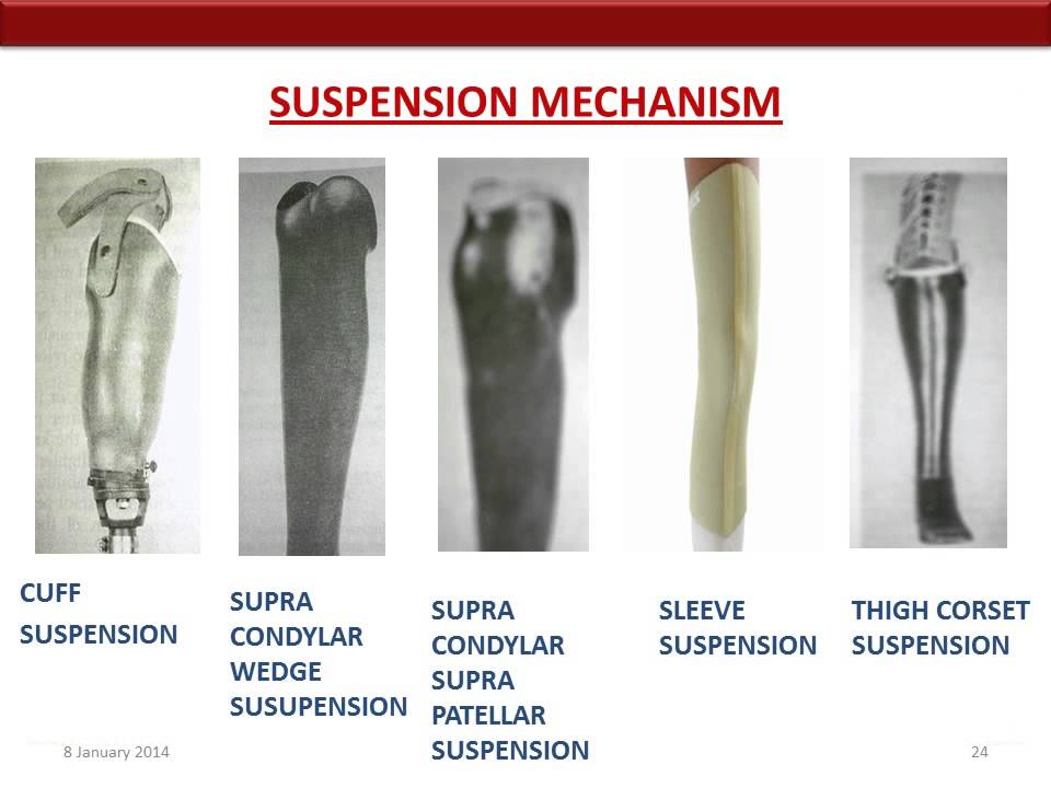 transtibial amputation