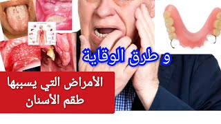 هل طقم الأسنان يسبب الأمراض الخطيرة ؟ ?و ما هي طرق الوقاية.تركيبات الأسنان المتحركة الكاملةوالجزئية