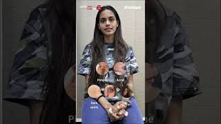 Real Results Karishma Kothari s Acne and Dark Spots Treatment Experience at Clear Skin