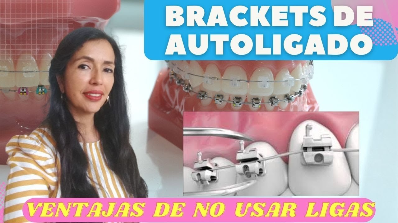 Brackets de Autoligado. Ventajas de NO usar ligas YouTube