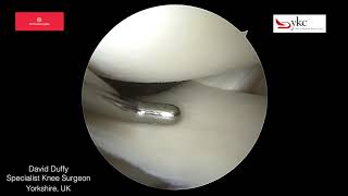 The Normal Meniscus