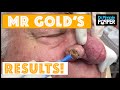 Results after Rhinophyma Treatment, Mr Gold