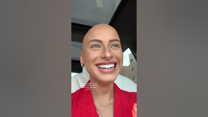 MY HAIR-LOSS JOURNEY #bald #alopecia #baldisbeautiful #inspiring #selflove #hairloss #shavedhead
